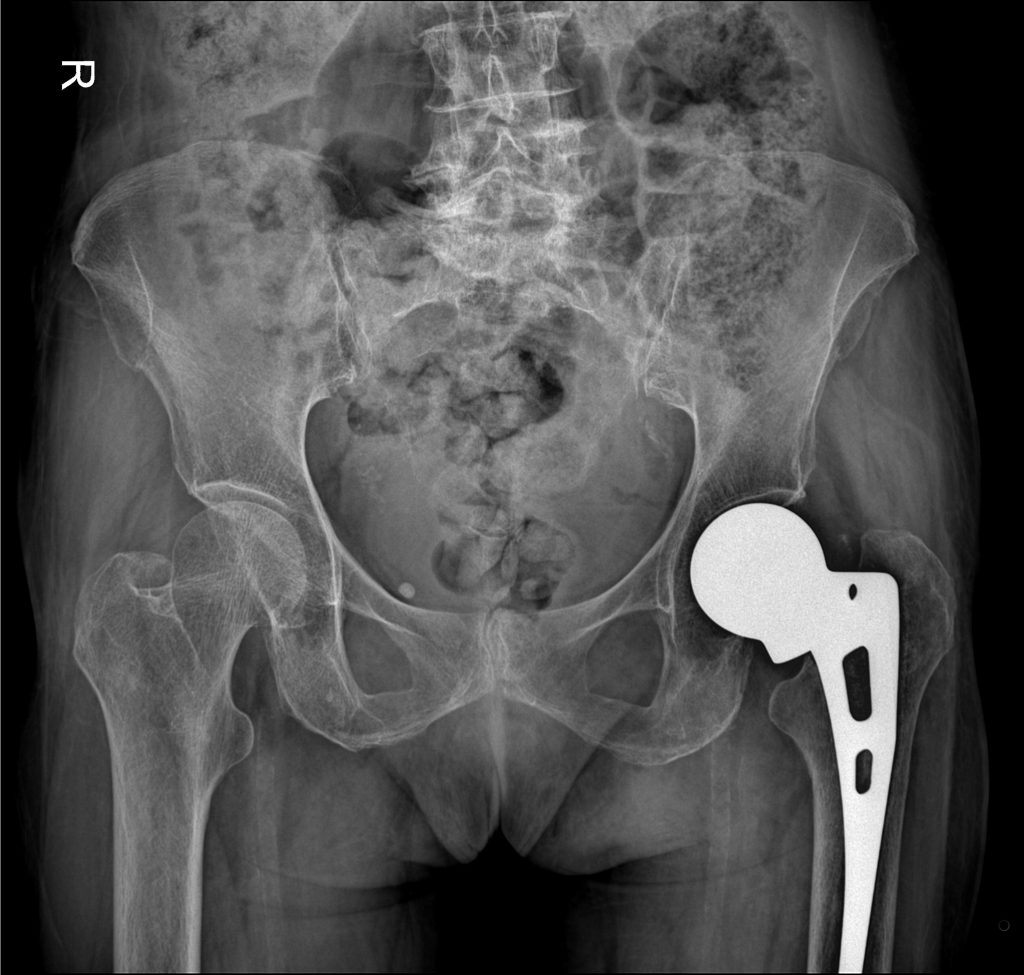 Implant - sztuczne biodro
